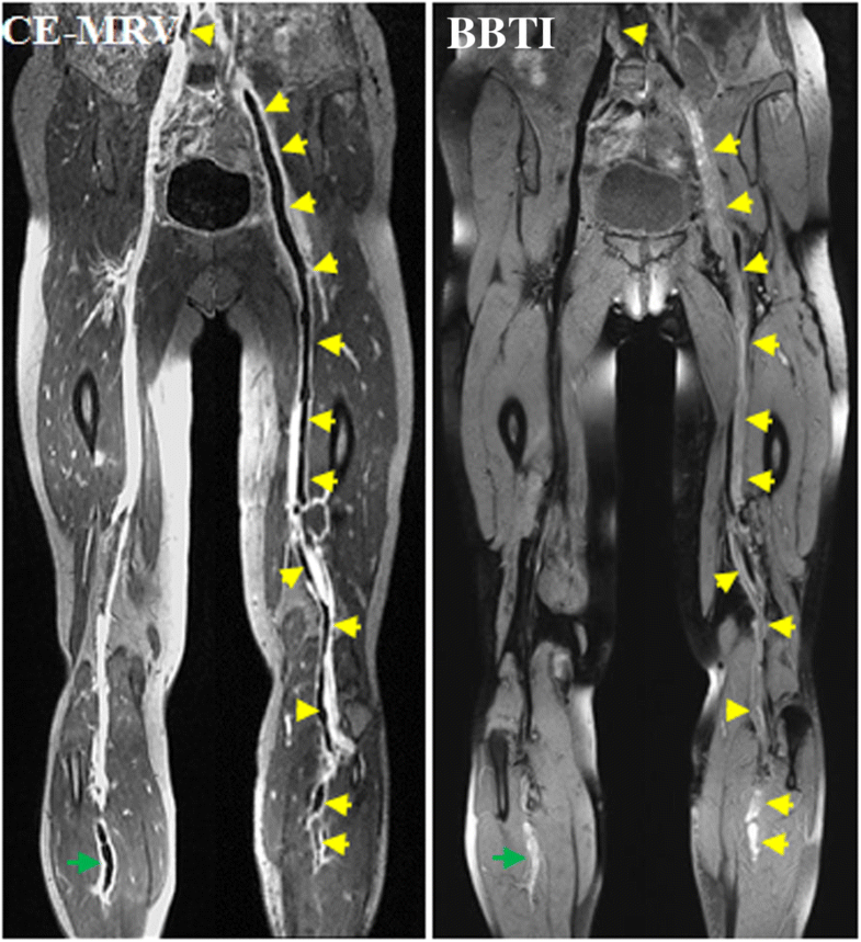 Cardiovascular resonance blackblood thrombus imaging for the