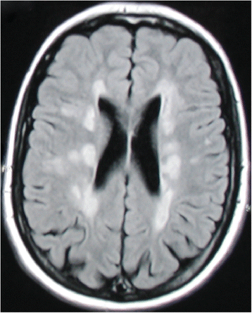 optic neuritis anti mog optic neuritis anti mog