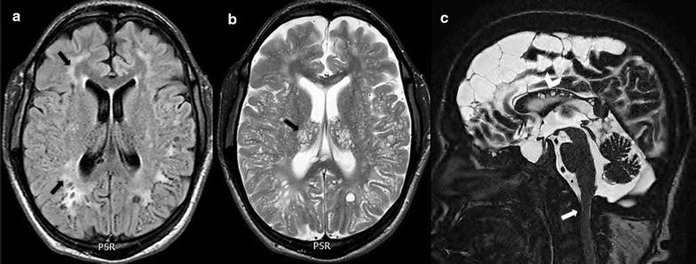 Correlation of CSF flow using phase-contrast MRI with ventriculomegaly ...