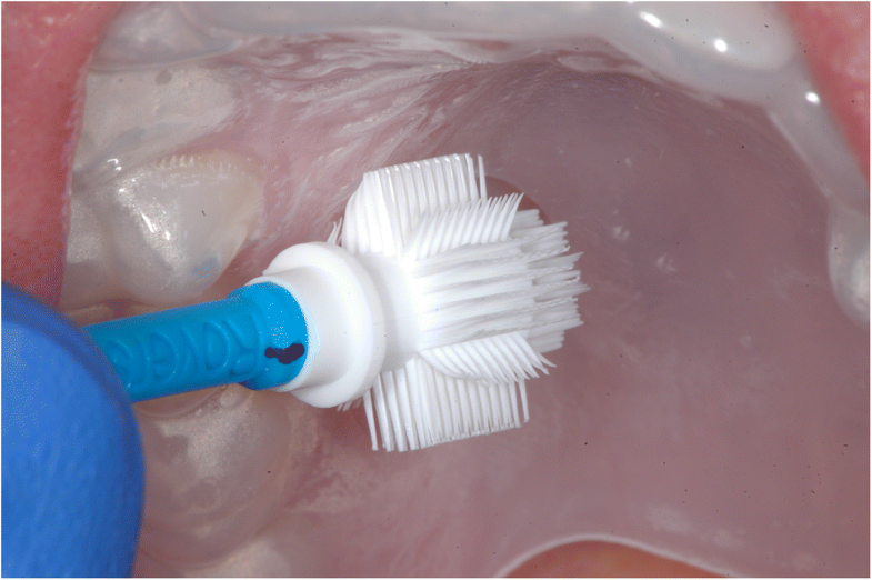 Clinical comparison of liquidbased and conventional cytology of oral