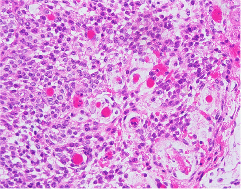 The glomus tumor resorbed bone and teeth in the mandible: a case report ...