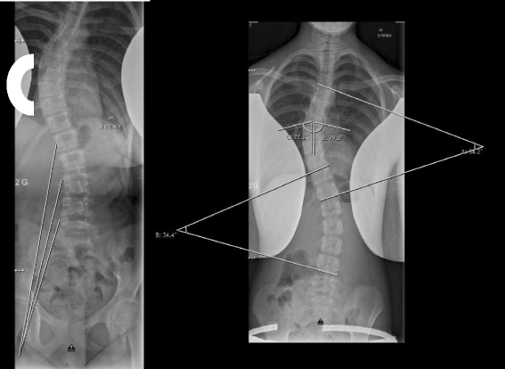 The role of the paravertebral muscles in adolescent idiopathic