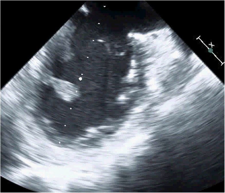Aspergillus mural endocarditis presenting with multiple cerebral