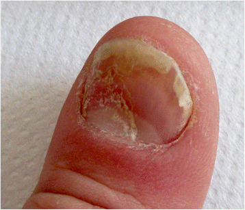 Transient yellow discoloration of the nails for differential diagnosis ...