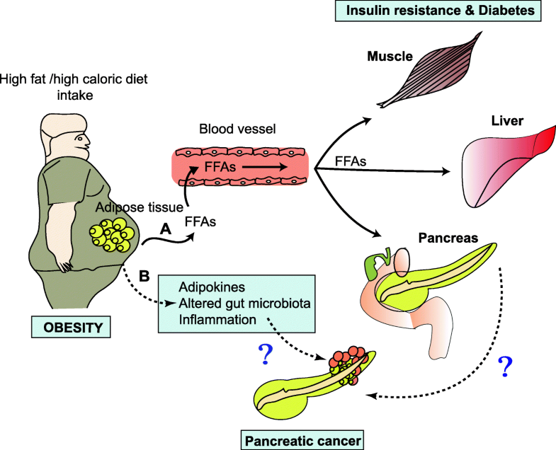 Pancreatic cancer associated with obesity and diabetes an alternative