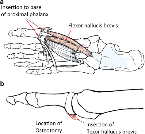 Surgical offloading procedures for diabetic foot ulcers ...