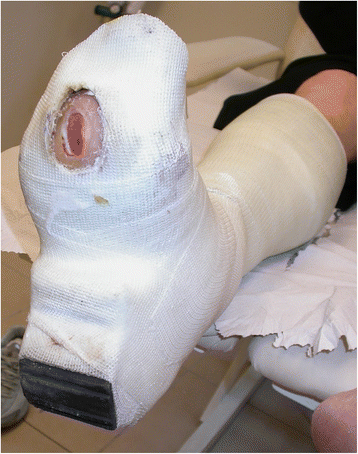 Surgical offloading procedures for diabetic foot ulcers compared to ...