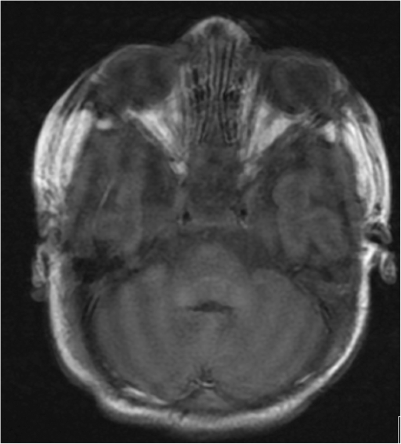 Vitamin K deficiency bleeding in an apparently healthy newborn infant