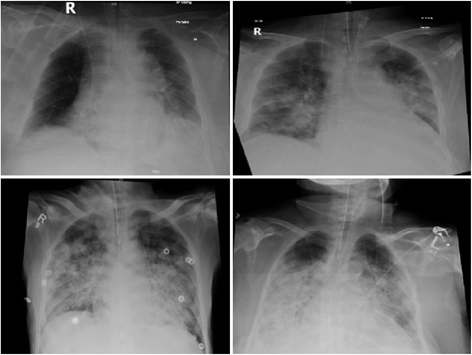 Critically ill patients with Middle East respiratory ...