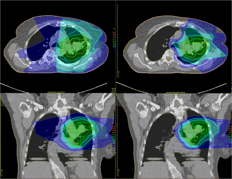 PRONTOX proton therapy to reduce acute normal tissue