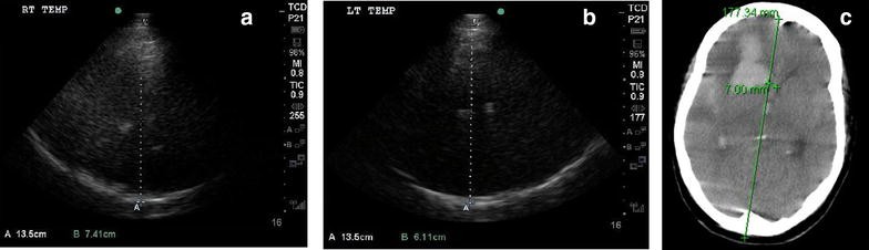 transcranial doppler transcranial doppler
