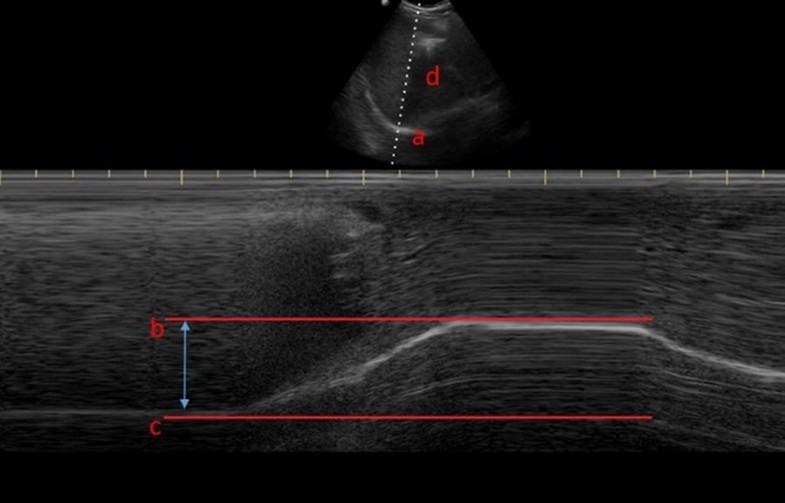 A narrative review of diaphragm ultrasound to predict weaning from