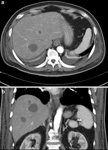 Invasive liver abscess syndrome predisposed by Klebsiella pneumoniae