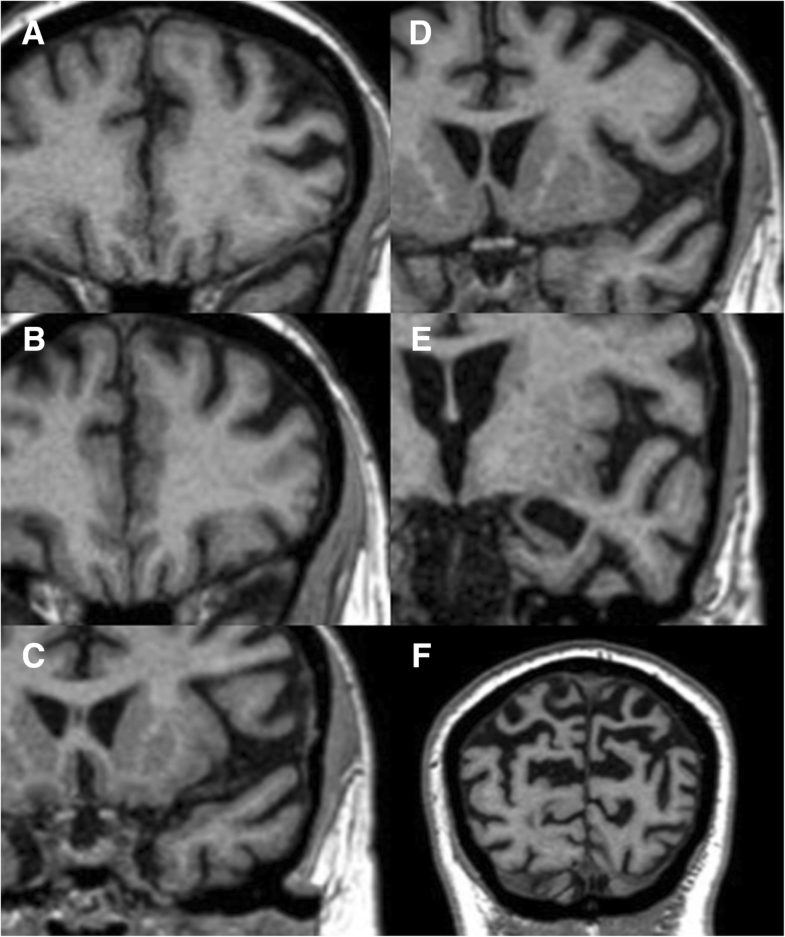 Neuroimaging Assessment In Down Syndrome: A Pictorial Review | SpringerLink