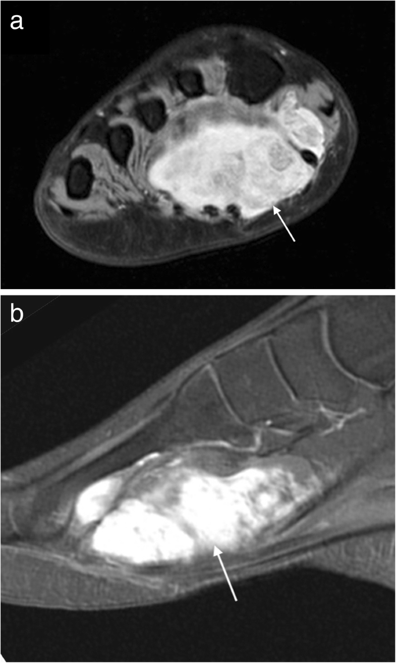 MRI imaging of soft tissue tumours of the foot and ankle Insights