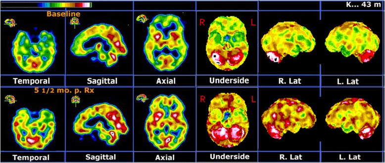 Ketamine and transcranial magnetic stimulation treatment ...