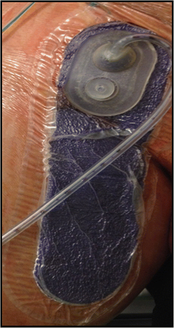 Effect of a new incision management system (PREVENA®) on wound healing