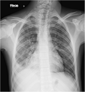 Toxoplasma gondii pseudocyst in a transbronchial biopsy: a case report ...