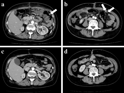 Giant gastric gastrointestinal stromal tumor with severe peritoneal ...