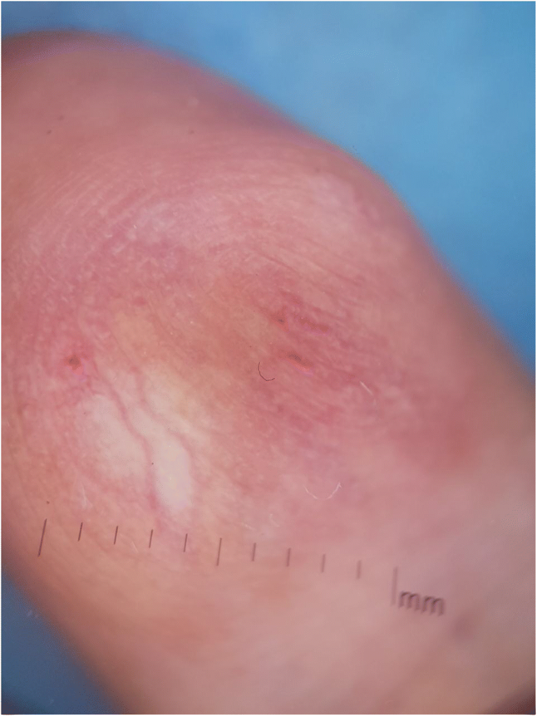 Rare tumor in unusual location glomus tumor of the finger pulp