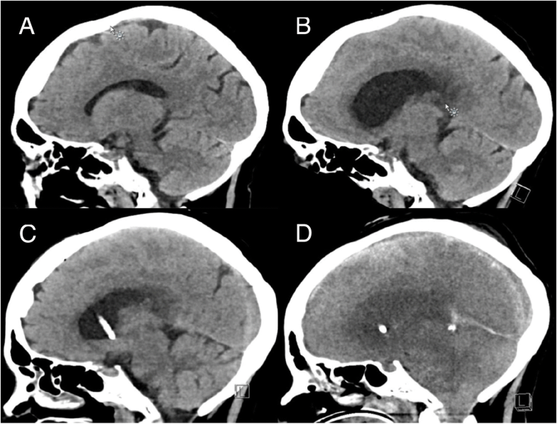 Meningitis in a patient with neutropenia due to Rothia mucilaginosa a
