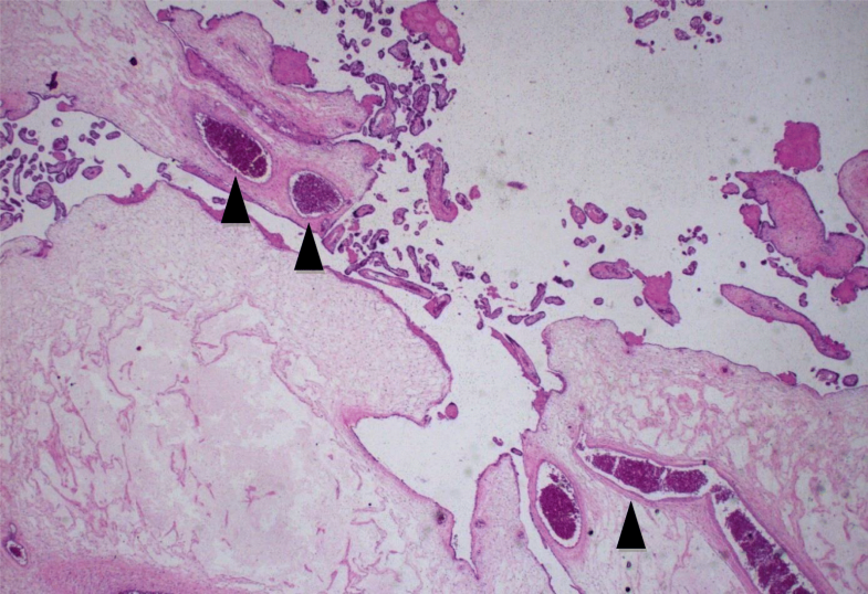 A partial molar pregnancy associated with a fetus with intrauterine