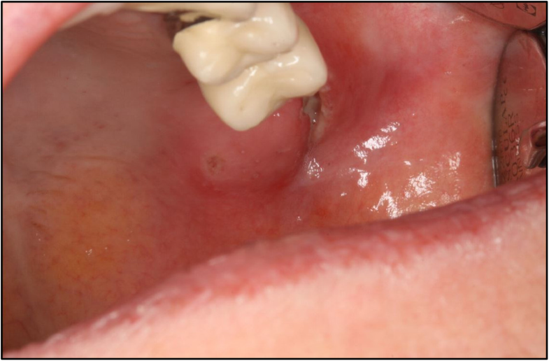 Lymph node abscess caused by Francisella tularensis a rare