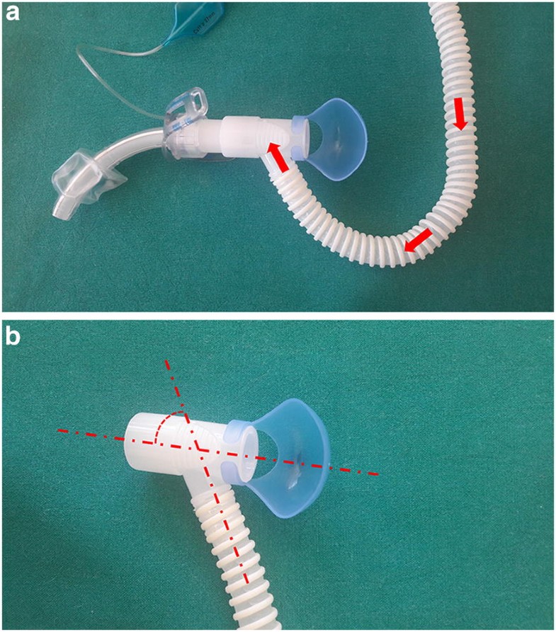 Highflow oxygen therapy in tracheostomized patients at high risk of