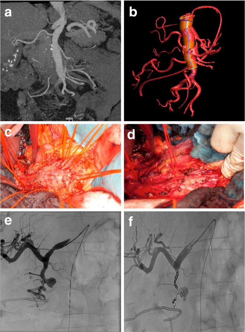 Visceral artery aneurysms evolving interdisciplinary management and