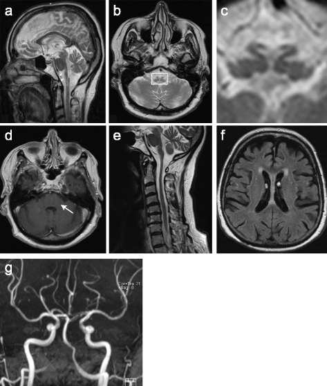 brain stem stroke brain stem stroke