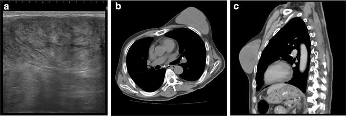 Large pseudoangiomatous stromal hyperplasia complicated with ...