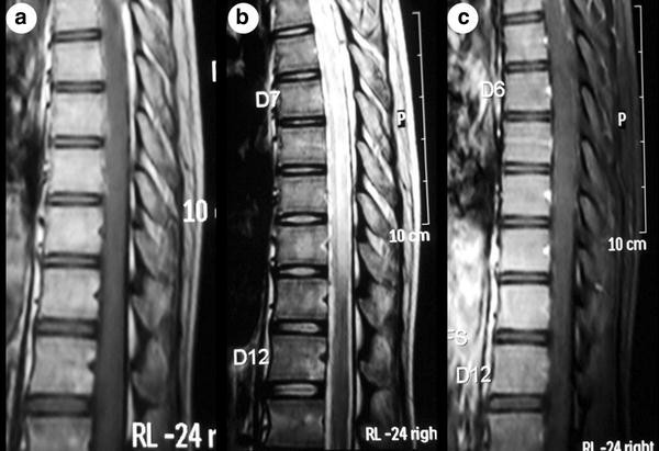 A Rare Association Of Tuberculous Longitudinally Extensive Transverse ...