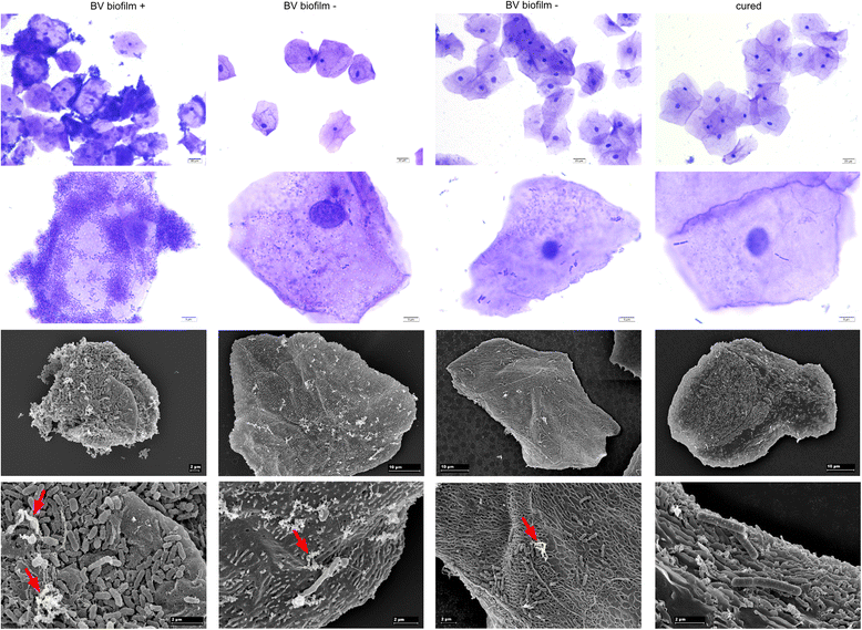 Treatment of biofilms in bacterial vaginosis by an amphoteric tenside