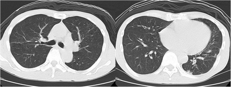 “Pulmonary Actinomycosis attributable to Actinomyces meyeri presenting ...