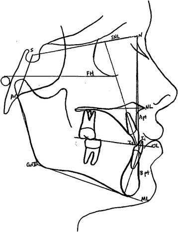 Comparison of two maxillary protraction protocols: tooth-borne versus ...