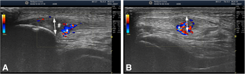 Current Trends In Tendinopathy: Consensus Of The ESSKA Basic Science ...