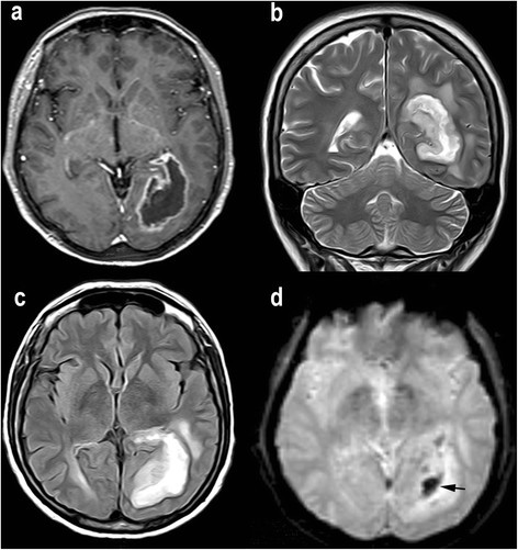 Added value of advanced over conventional magnetic resonance imaging in ...