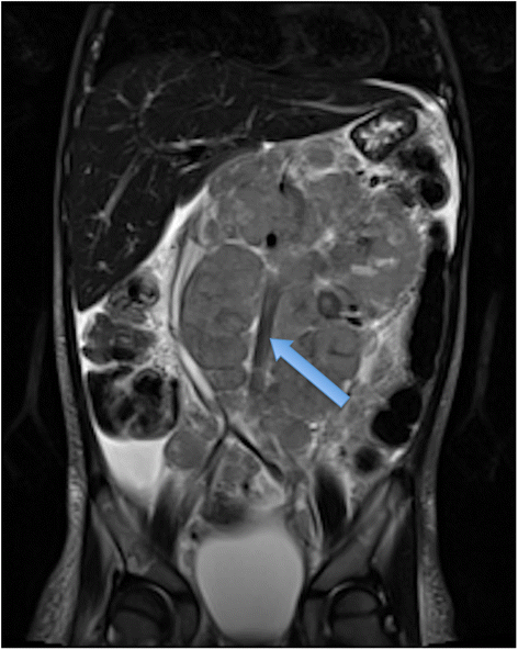 Neuroblastoma And Nephroblastoma: A Radiological Review | Cancer ...