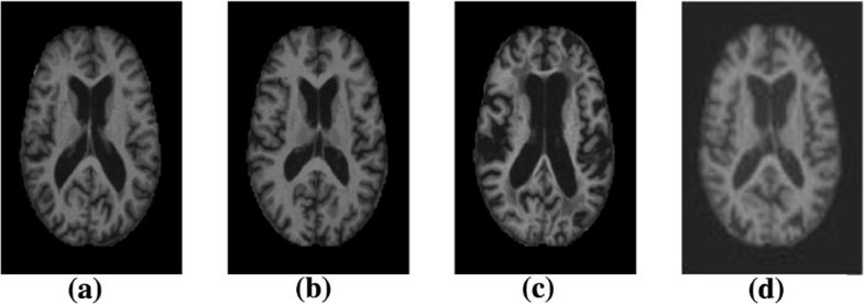 Brain MRI analysis for Alzheimer’s disease diagnosis using an ensemble ...