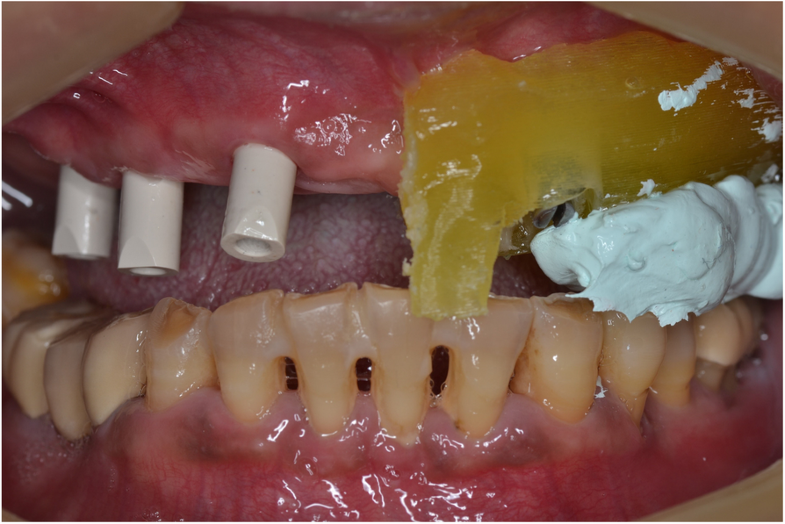 Using the surgical guide for impressionfree digital bite registration in the edentulous maxilla