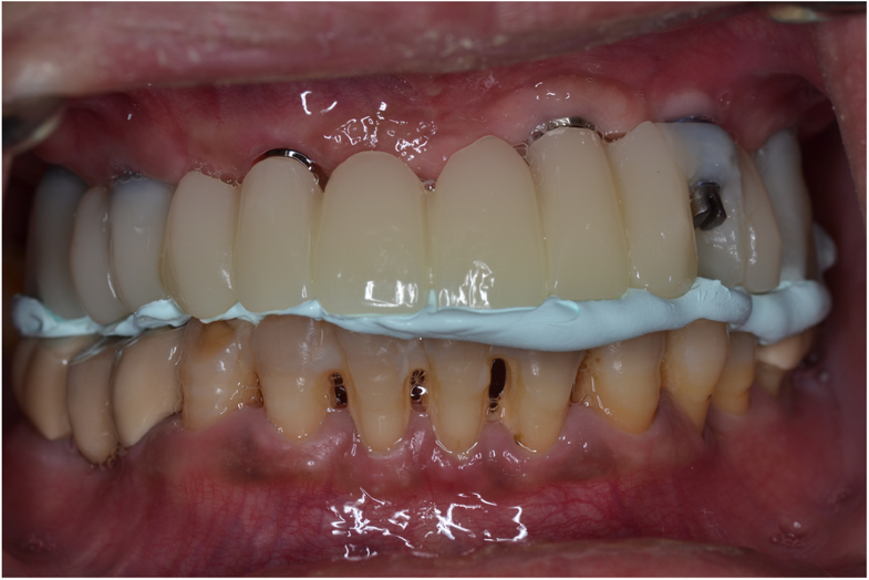 Using the surgical guide for impressionfree digital bite registration in the edentulous maxilla