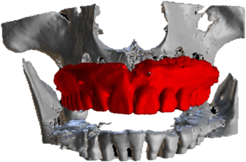 Using the surgical guide for impressionfree digital bite registration in the edentulous maxilla