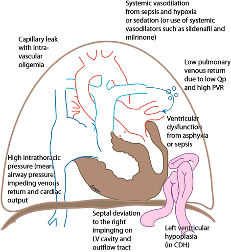 Persistent pulmonary hypertension of the newborn | Maternal Health