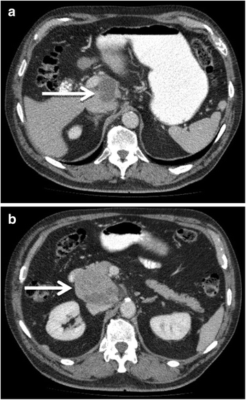 A hepatoid carcinoma of the pancreatic head | Surgical Case Reports ...