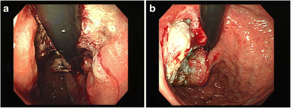 Stage IV gastric cancer successfully treated by