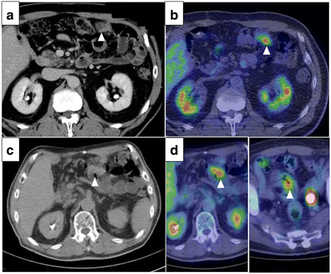 hilar cholangiocarcinoma peritoneal surgery dissemination recurrent fig ct case r0 resection survivor term report long after detected pet