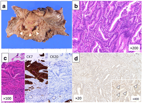 hilar cholangiocarcinoma peritoneal fig resection dissemination case r0 recurrent survivor surgery term report