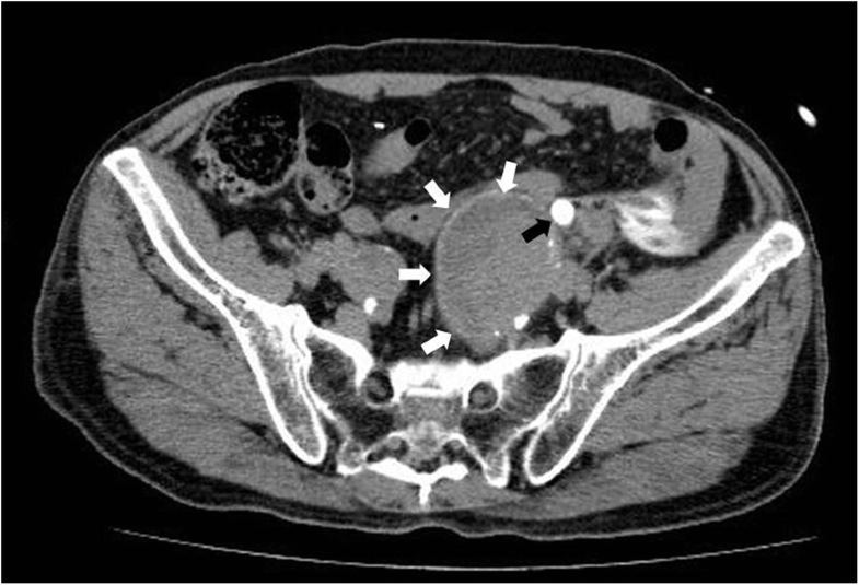 Spontaneous ureteral rupture caused by iliac aneurysm a case report Surgical Case Reports