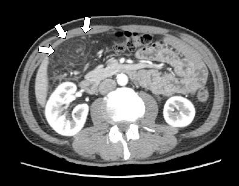 Laparoscopic omentectomy in primary torsion of the greater omentum