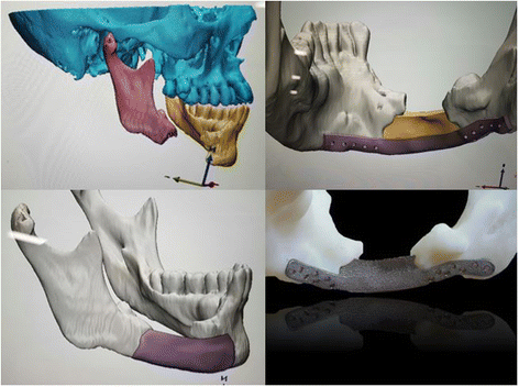 Recent advances in the reconstruction of cranio-maxillofacial defects ...